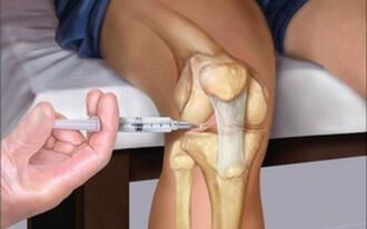 intraarticular injection into the joint in arthrosis