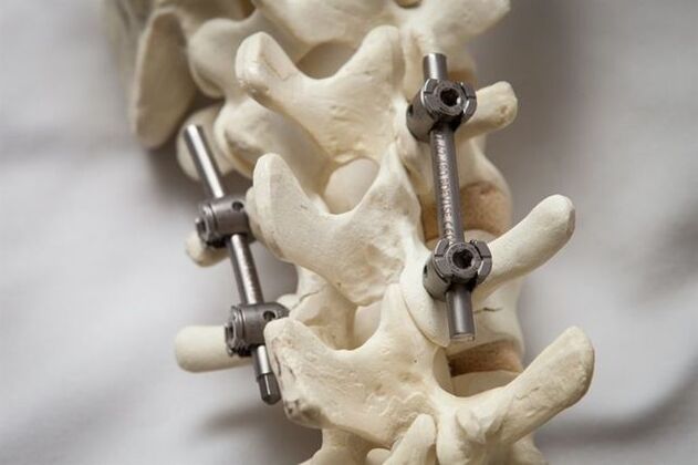fixation of the spine in osteochondrosis of the neck