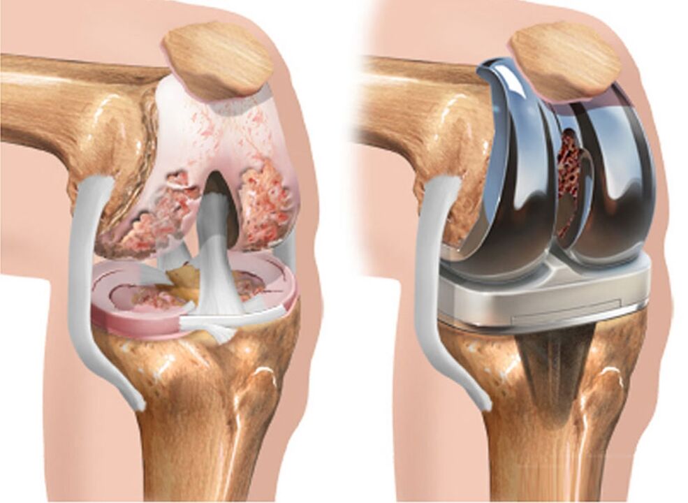 before and after osteoarthritis of the knee in case of arthrosis