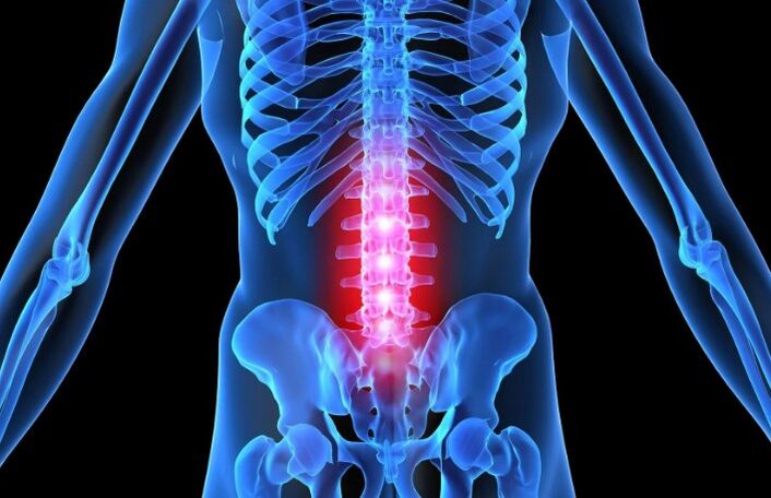 The lumbar region osteochondrosis