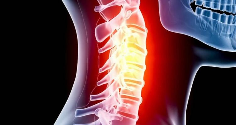 Inflammation of the cervical region