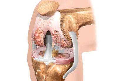 The knee joint joint damage