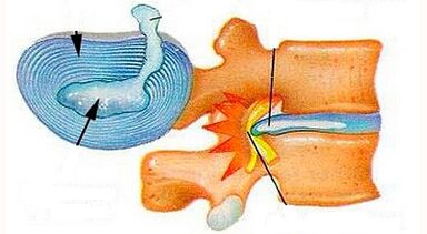 Characteristics of the Cervical Osteochondrosis