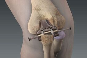 knee prosthesis in case of arthrosis